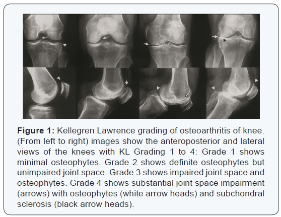 osteoarthritis radiology grades