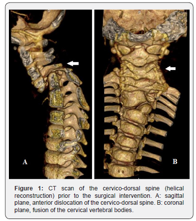 Journal of Head Neck & Spine Surgery