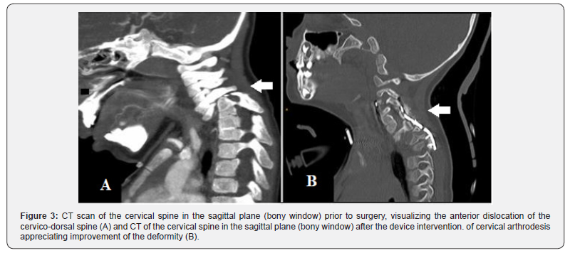 Journal of Head Neck & Spine Surgery