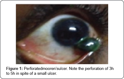 Open Access Ophthalmology Journal Juniper Publishers