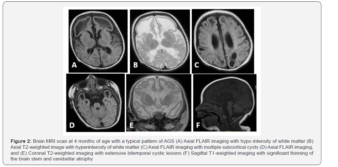 Further Brain Magnetic Resonance Imaging (MRI) Delineation of Aicardi ...