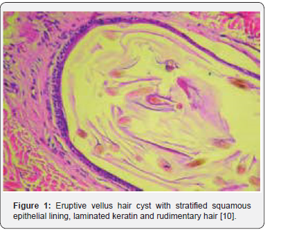 Monomorphic or Multivariate - Eruptive Vellus Hair Cyst