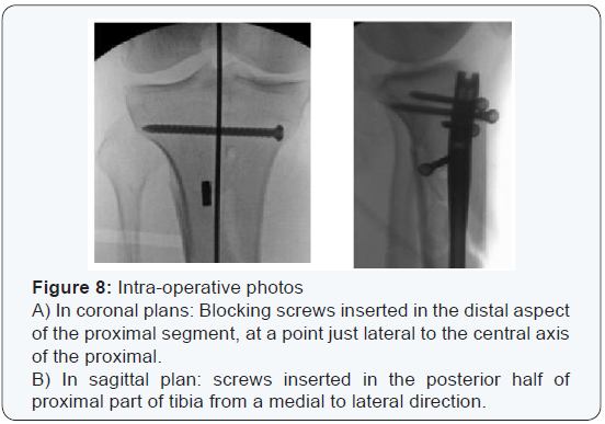 Native tibia valga: a potential source of varus malreduction during  intramedullary tibial nail fixation of tibial shaft fractures |  International Orthopaedics